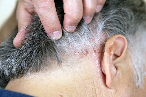 older man with scalp psoriasis