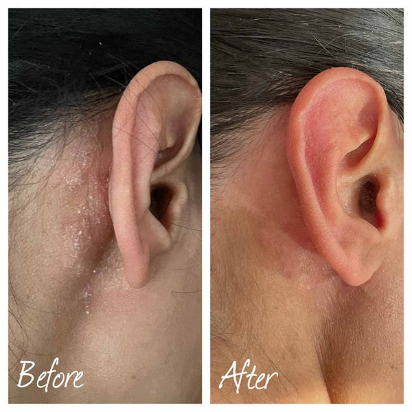 before and after using scalp serum showing psoriasis has reduced