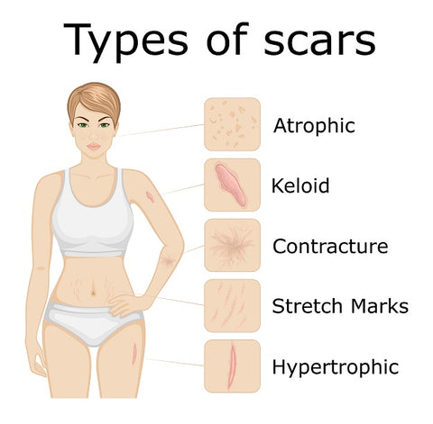 Learn about the different types of scars