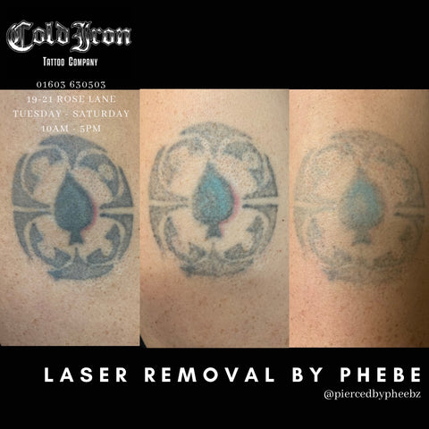 Laser Removal – Cold Iron Tattoo Company
