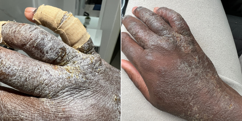 topical steroid withdrawal hands