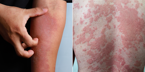 eczema/ psoriasis skin conditions / atopic dermatitis