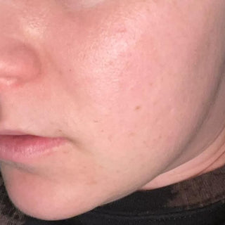 BTBS Blemish-Prone Skin Regimen | B+A Grid 2 Image File [After]