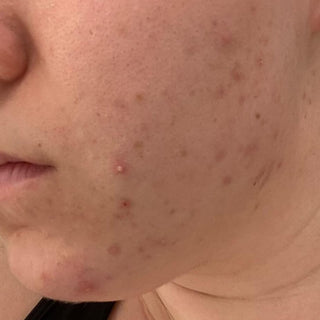 BTBS Blemish-Prone Skin Regimen | B+A Grid 1 Image File [Before]