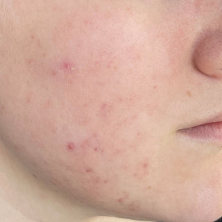 BTBS Blemish-Prone Skin Regimen | B+A Grid 4 Image File [After]