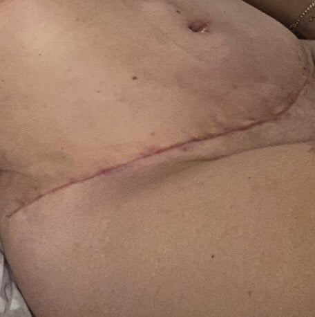 Homepage image for Surgery Scars.JPG__PID:b5e9a250-0818-4b42-8f3c-70761d91313f