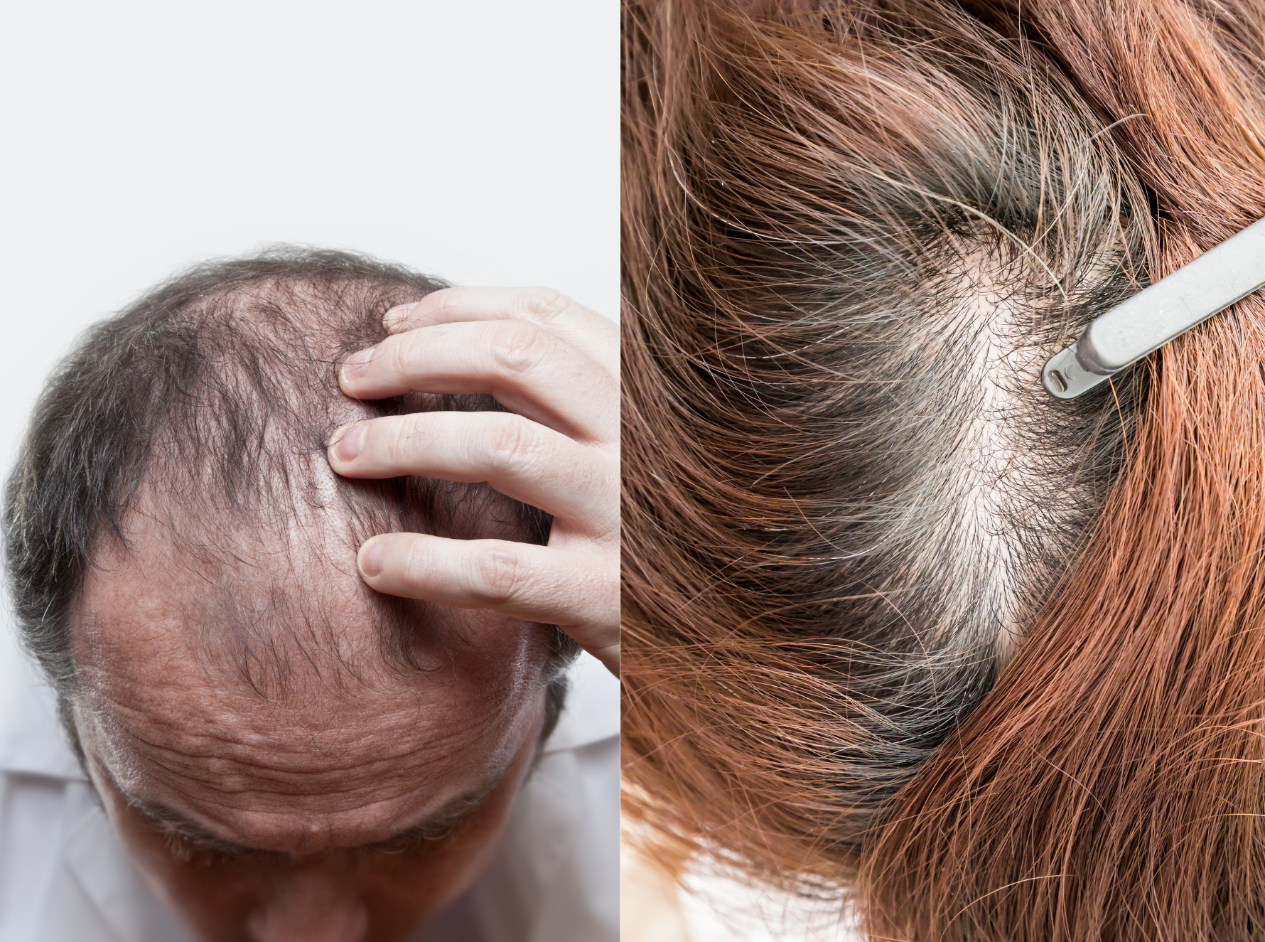 Is Your Hair Loss a Sign of Low Testosterone  LT Mens CLinic