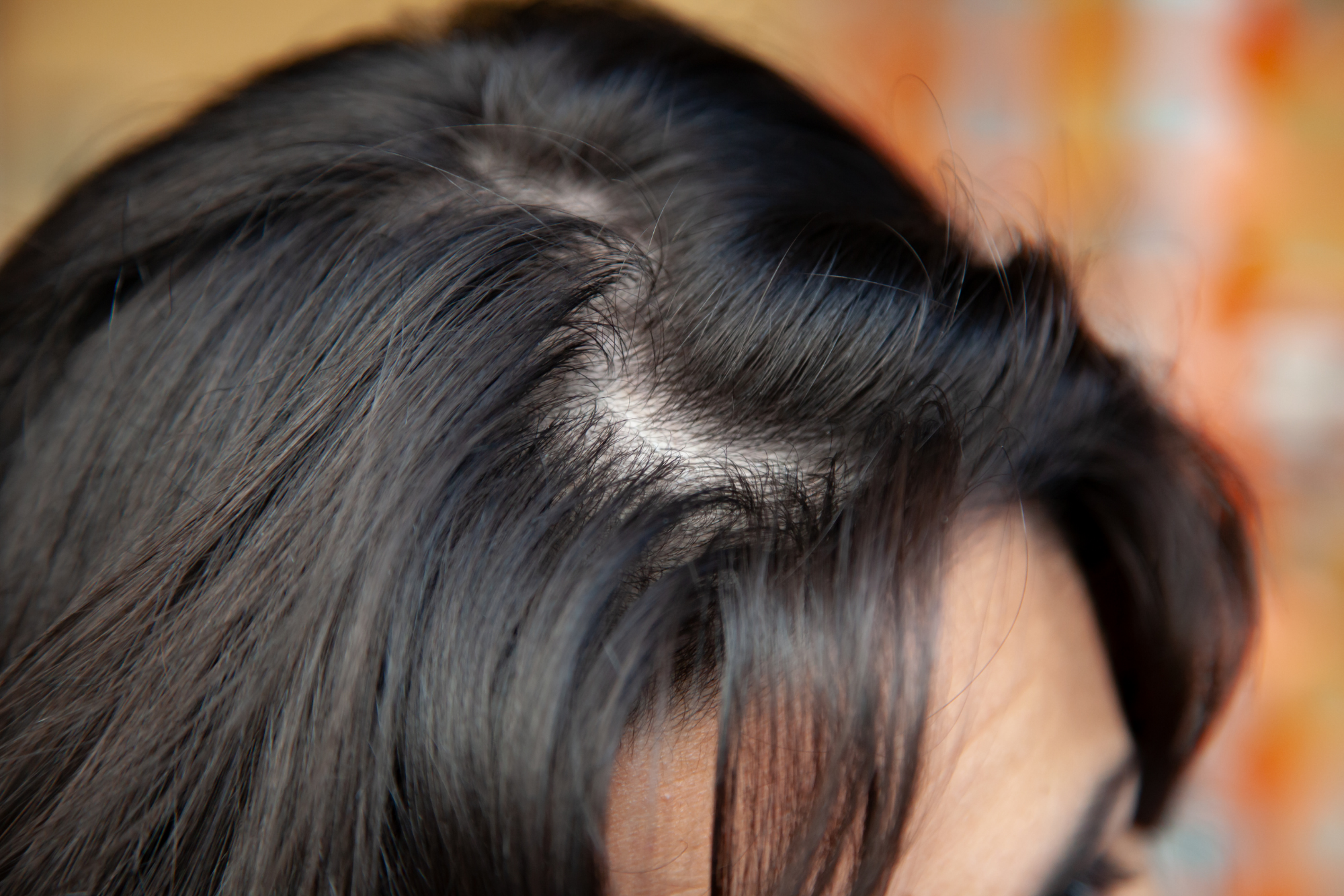 What Does Thinning Hair Look Like & How to Stop It | Revela