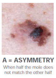 SkinCancer Asymmetry