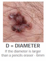 SkinCancer Diameter