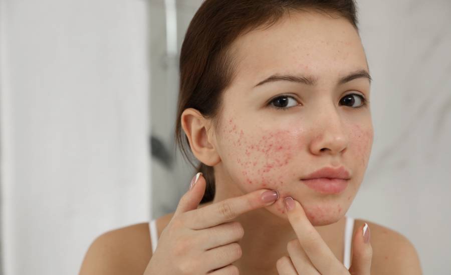 Prendi le misure giuste per prevenire l'acne e farla scomparire!