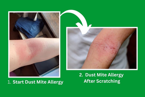 Image of what a Dust Mite bite looks like before and after scratching
