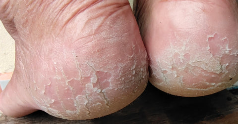 Why Lotion Never Fixes Cracked Heels and Dry Feet – Dr.Berg - YouTube