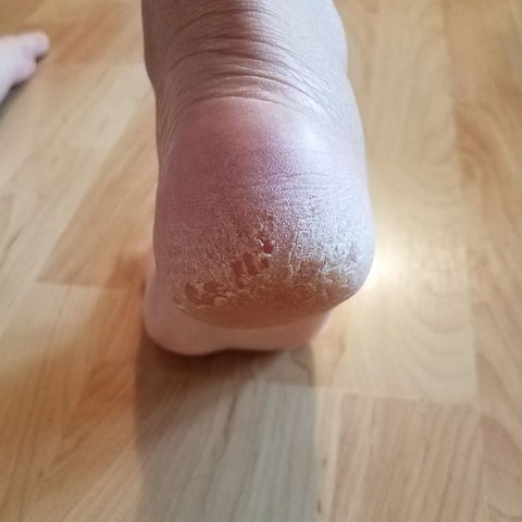 Crusty Feet