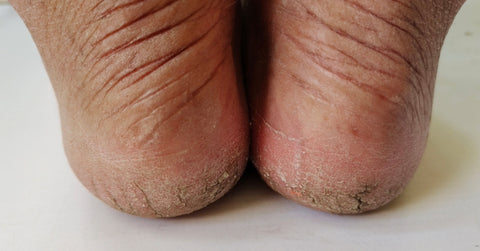 Image of cracked heels