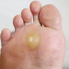 Callus under foot