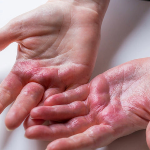 Image of hands experiencing hand eczema symptoms