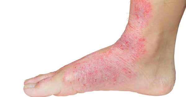 Psoriasis symptoms on foot and ankle