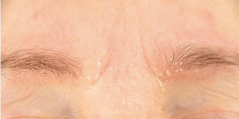 Example of eyebrow dandruff