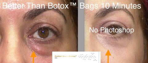 Professional Edition Better than Botox Eye bag removal 10 Minutes Before and After Treatment Results