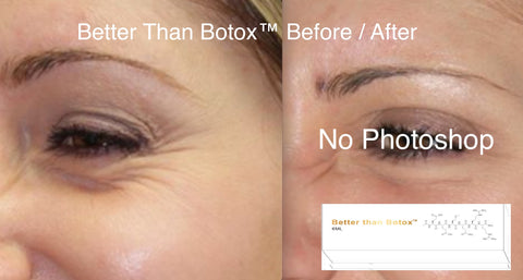Professional Edition Better than Botox 30 day Before and After Treatment Results
