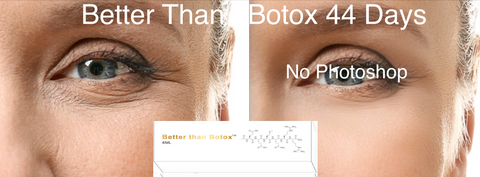 Professional Edition Better than Botox Under Eye Bag removal for eyes instant Before and After Treatment Results