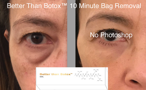 Under eye bag removal Instant Professional Edition Better than Botox Before and After Treatment Results