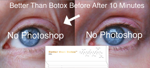 Professional Edition Better than Botox 30 day Before and After Treatment Results