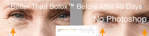 Professional Edition Better than Botox 30 day Before and After Treatment Results