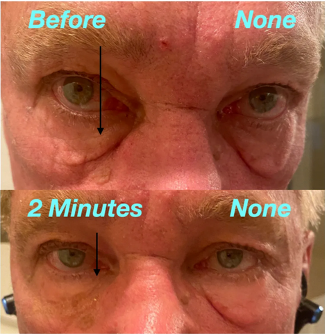 Male Under Eye bags 10 min removal Professional Edition Better than Botox 30 day Before and After Treatment Results