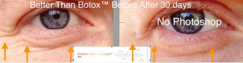 Professional Edition Better than Botox 30 day Before and After Treatment Results Anti-aging Treatment