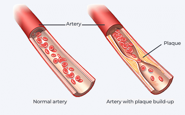Diagram of Atherosclerosis