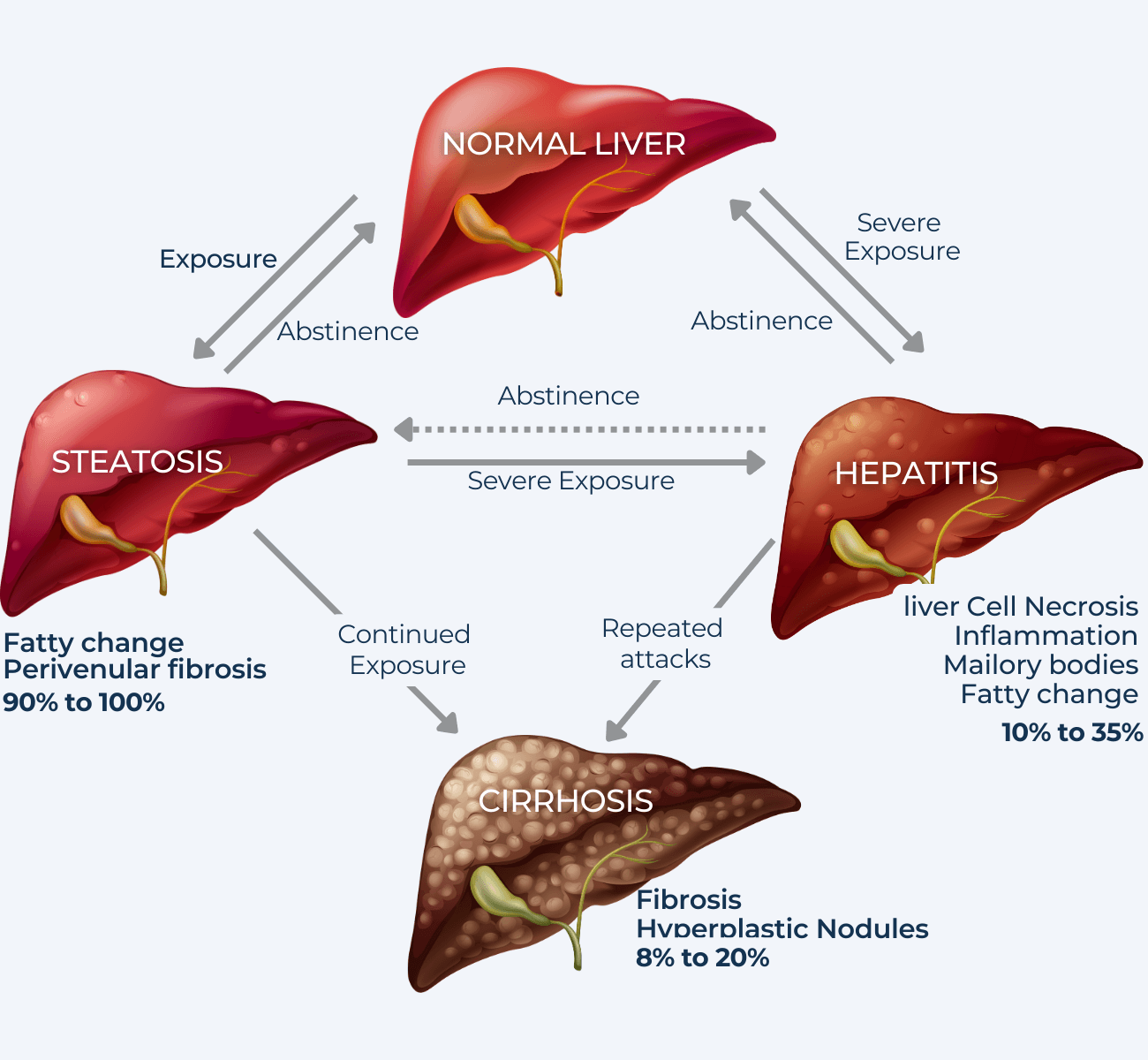 Illustration of the Stages of Liver Damage
