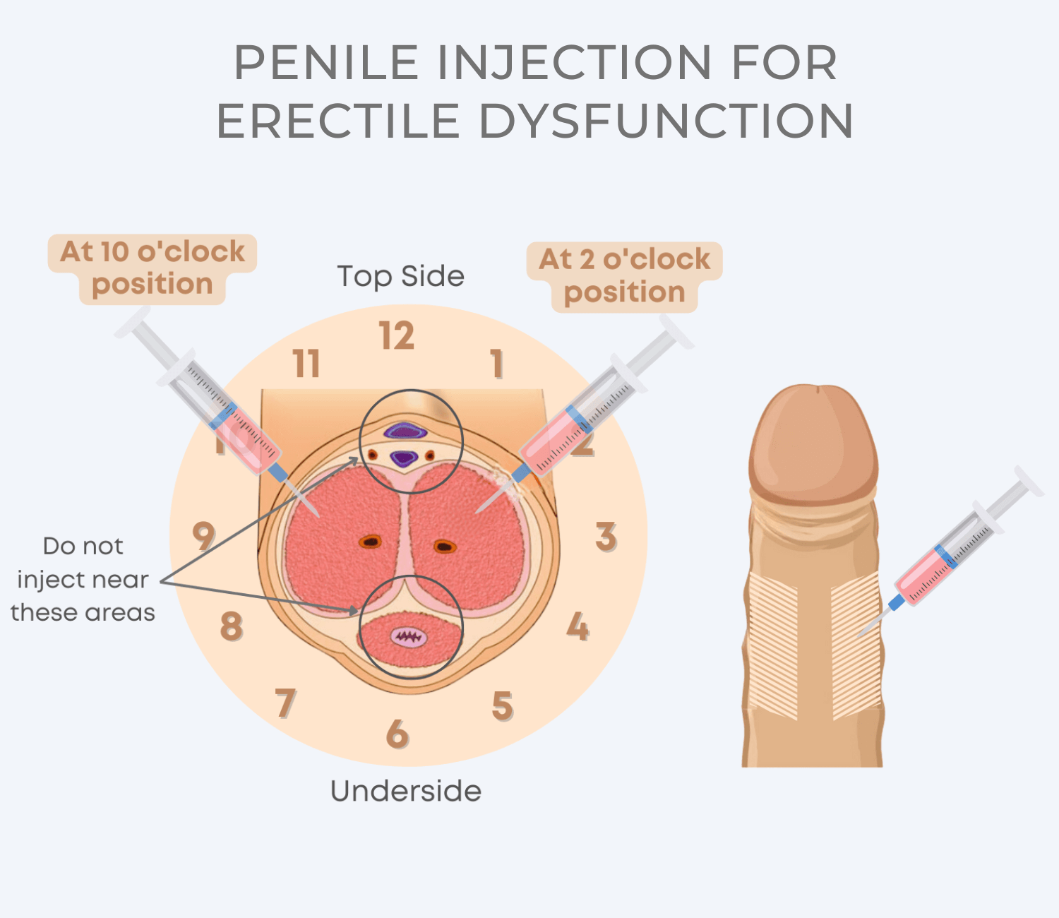 Penile Injection for Erectile Dysfunction Illustration