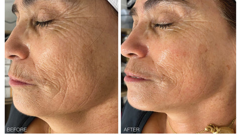Before and after images of a female client after receiving a wet/dry microdermabrasion service