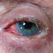 Conjunctivitis.jpg__PID:89da1858-64cf-4a1c-9ca0-77aa9f9480a8