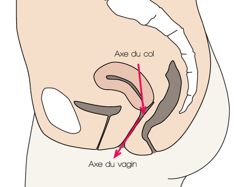 Extracción del DIU del eje del cuello uterino y la vagina