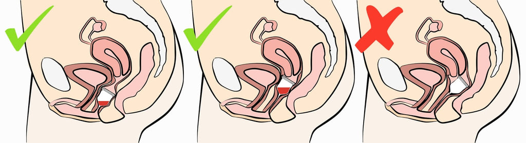 colocación correcta de la copa menstrual en la vagina