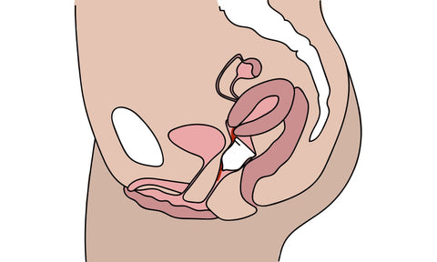 Menstruationstasse und retrovertierter Uterus mit niedrigem Muttermund unmöglich