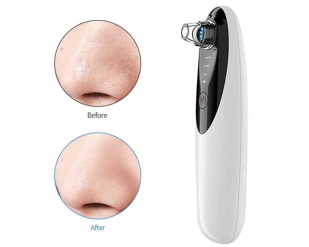 One of the Most Useful Ways to Remove Blackheads is to Use a Blackhead Vacuum