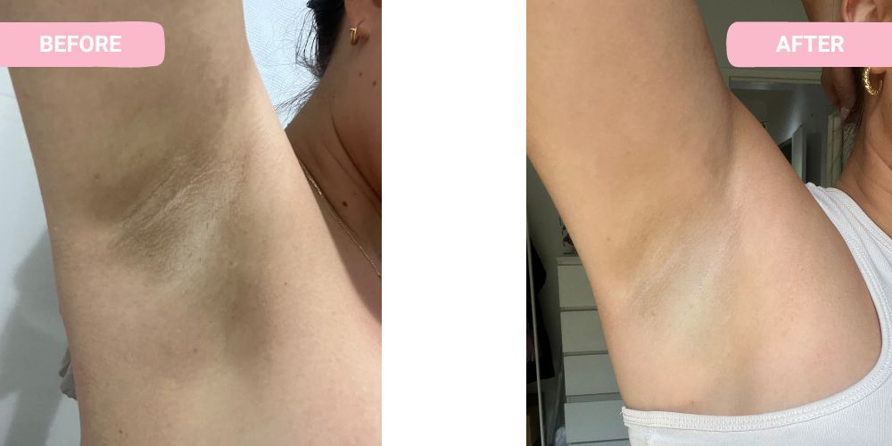 Under Butt Whitening After 1 Session Only. 😱 Whiten that Under Butt  without spending that much with Marikit Pico Laser Whitening. ✨
