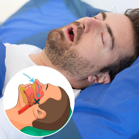 Adjustable Anti-Snoring Mouthpiece