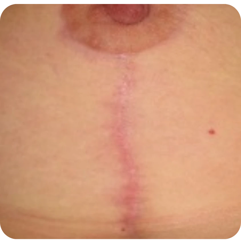heal breast surgery scar