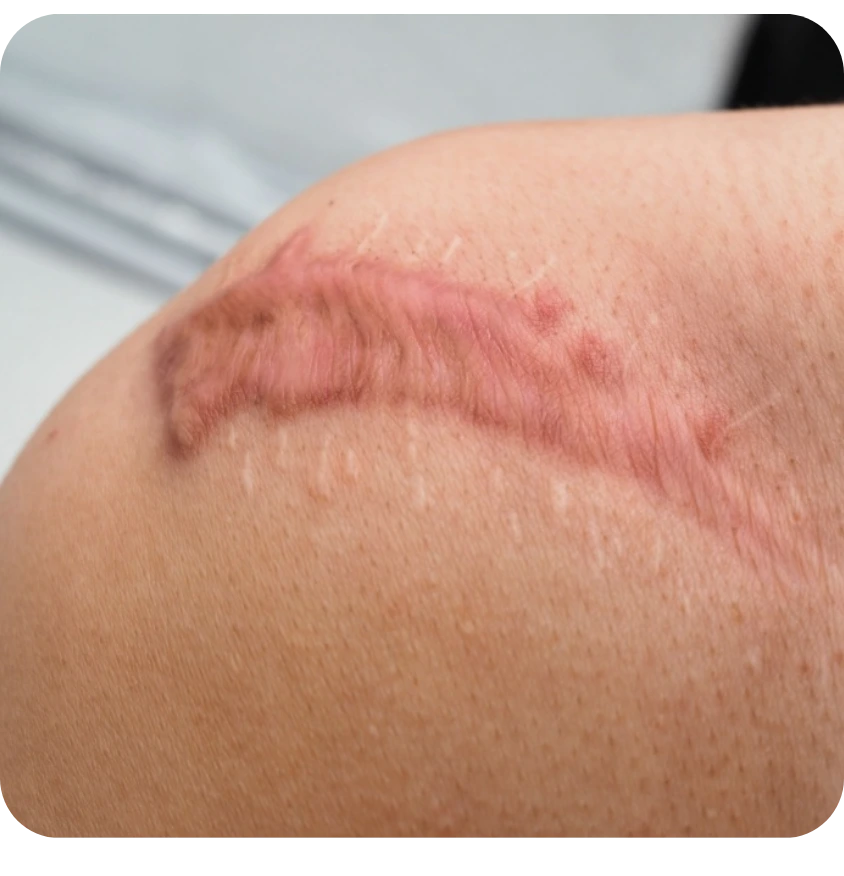 how to remove surgical scar