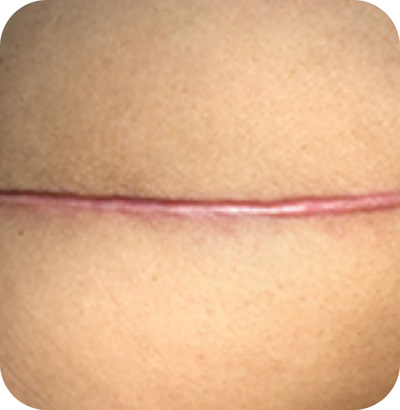 caesarian scar
