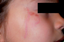 Cheekbone Laceration Scar