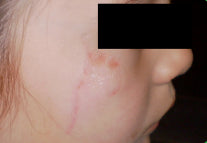 Cheekbone Laceration Scar after 4 months
