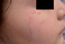 Cheekbone Laceration Scar end of treatment