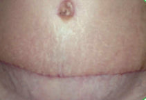 Liposuction and Abdominoplasty Scar