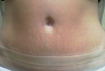 Liposuction and Abdominoplasty Scar after 10 days